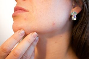 a girl using accutane for acne