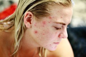 a girl's face with acne